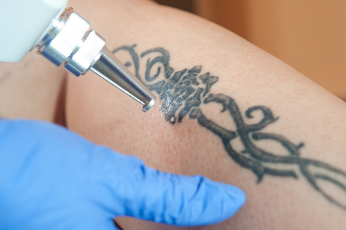 Are Scars and Blisters Possible During Laser Tattoo Removal?