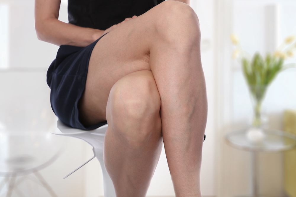Woman with spider veins