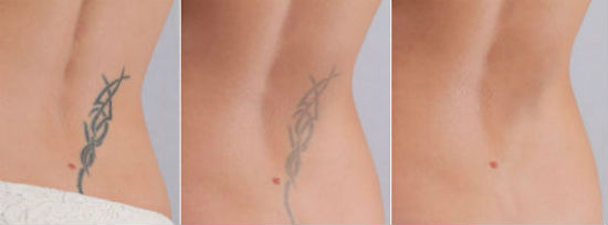 5 Things to Think About Before Removing Your Tattoo 5 Things to Think About Before Removing Your Tattoo