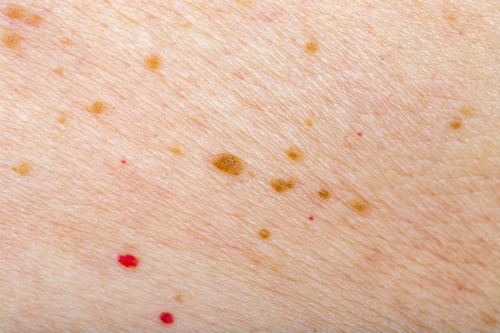 Removal Options For A Cherry Angioma 