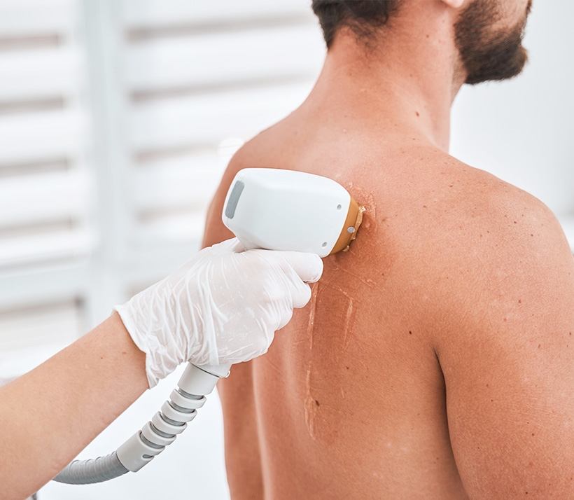 Cherry Angioma Removal Photo