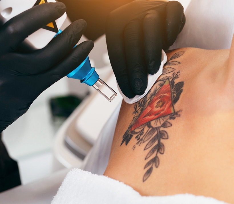Laser Tattoo Removal Photo