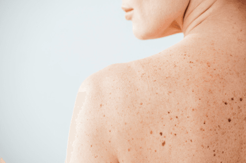 An Overview of Moles Photo