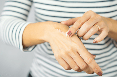 What Should You Know Before Your Laser Treatment for a Scar? Photo