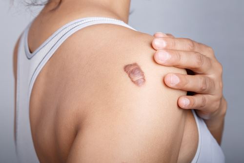 A Quick Guide to Keloids and Keloid Scar Revision Photo