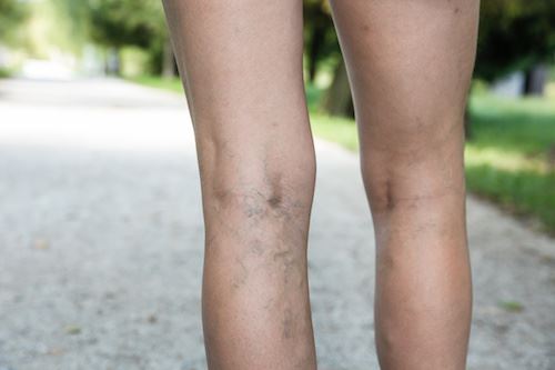 Are You One of the Many Suffering from Spider Veins? Photo