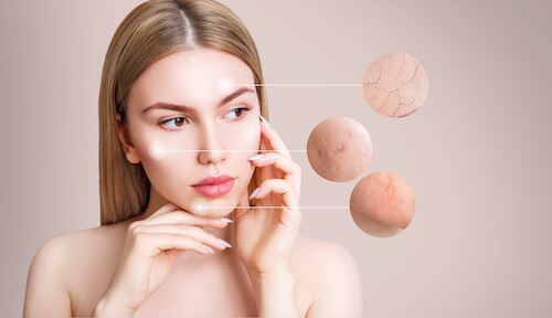 How to Tell the Difference Between Acne vs Rosacea Photo