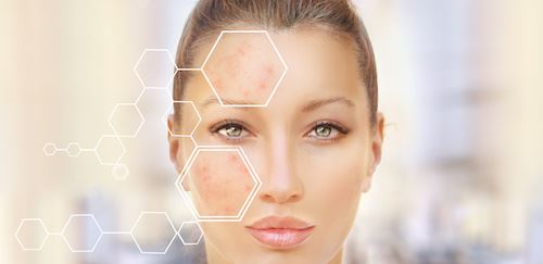 What Causes Acne Scars? Photo