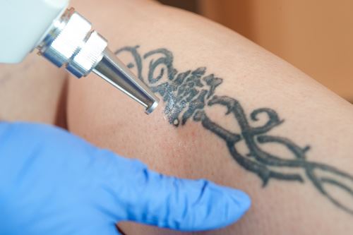 Are Scars and Blisters Possible During Laser Tattoo Removal? Photo