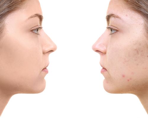 Treatment Options for Acne Scars Photo
