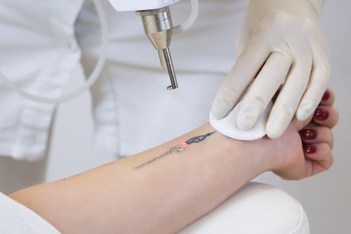 Laser Tattoo Removal Experience at Skin Deep Laser Services Virginia Photo