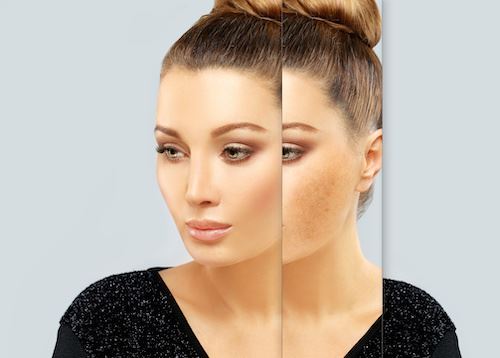 The Reasons Why Hyperpigmentation is so Hard to Get Rid Of Photo