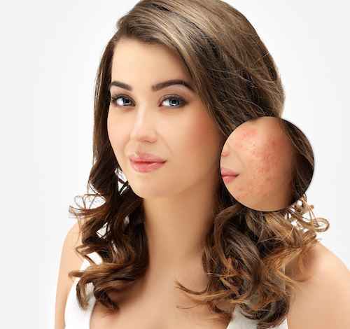 How Acne Scar Laser Treatments Work Photo