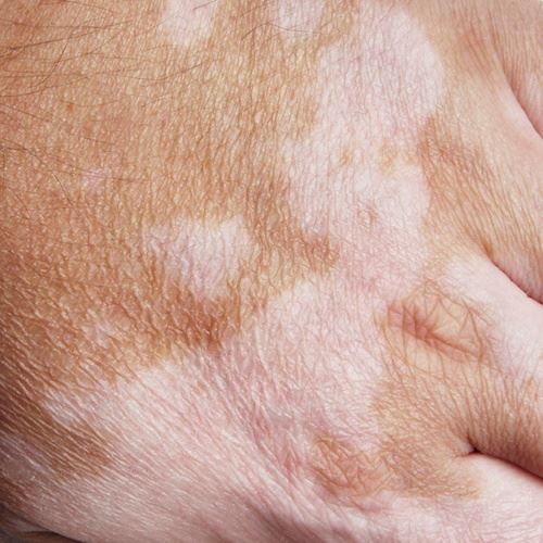 What are Pigmented Lesions and How Can They be Treated? Photo