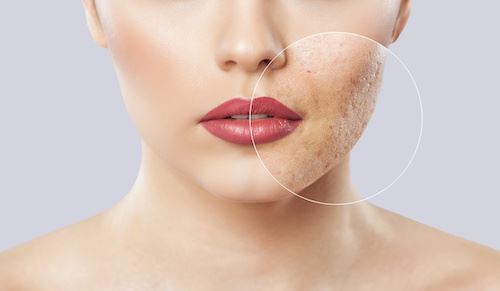 The Different Types of Acne Scars and Ways to Treat Them Photo