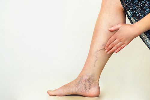 When Could Spider Veins be More Than a Cosmetic Problem? Photo