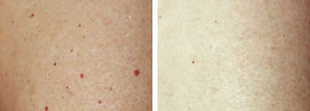 Red Mole (Cherry Angioma) Laser Removal Photo