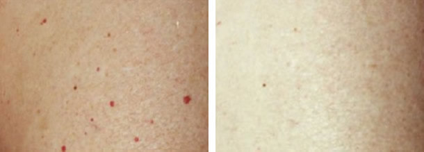 Red Mole Cherry Angioma Laser Removal 