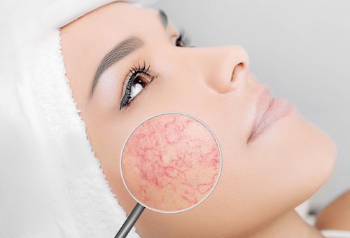 Don’t Let Rosacea Control Your Life Photo