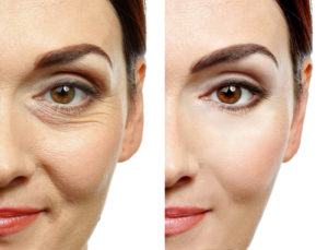 Everything You Need to Know About Madonna Eye Lift Recovery Photo