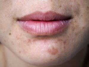 Everything You Should Know About Acne Scar Revision Photo