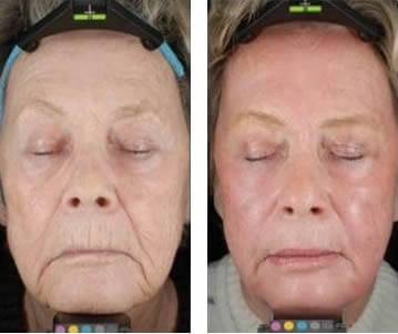 CO2 Laser Treatment For Acne Scarring Photo