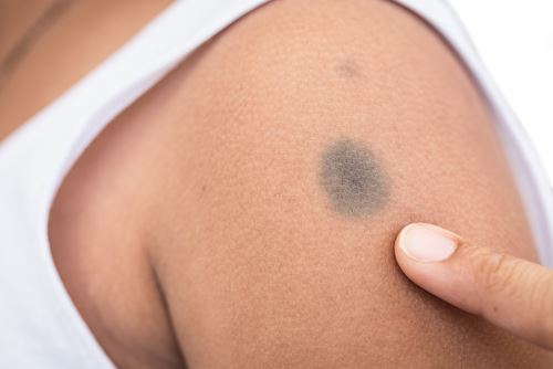 How Can Lasers Treat Your Pigmented Lesion? Photo