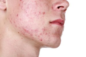 How to Prepare for Laser Acne Scar Removal Photo