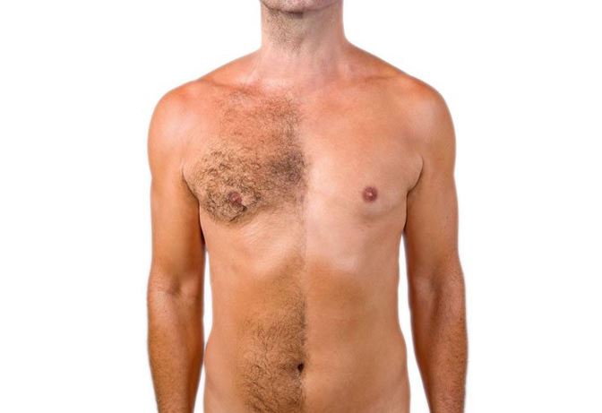 LASER HAIR REMOVAL IN THE FAIRFAX VA AREA Photo
