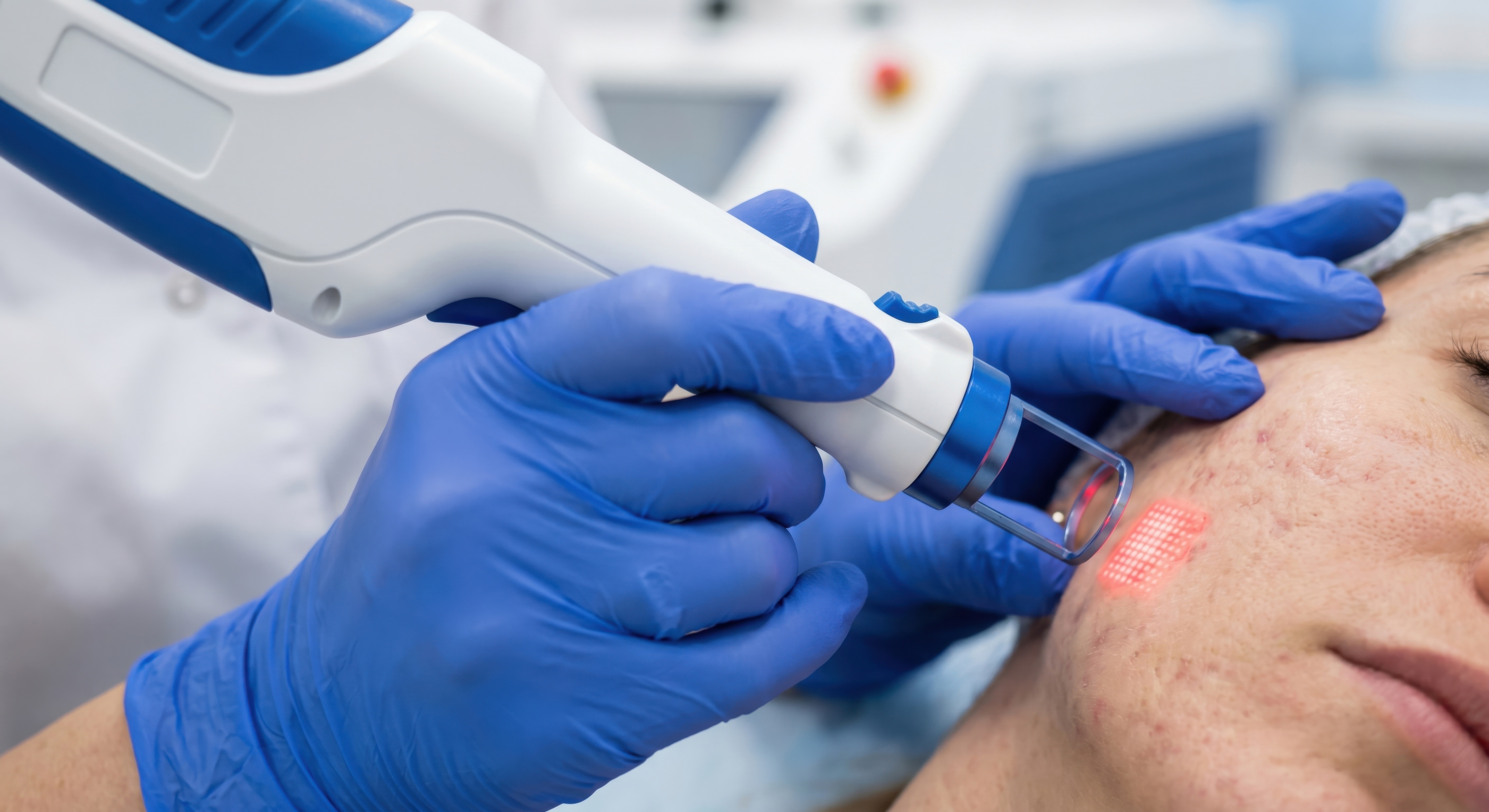 From Pitted to Polished: How Fractional CO2 Lasers Remodel Acne Scars from the Inside Out Photo