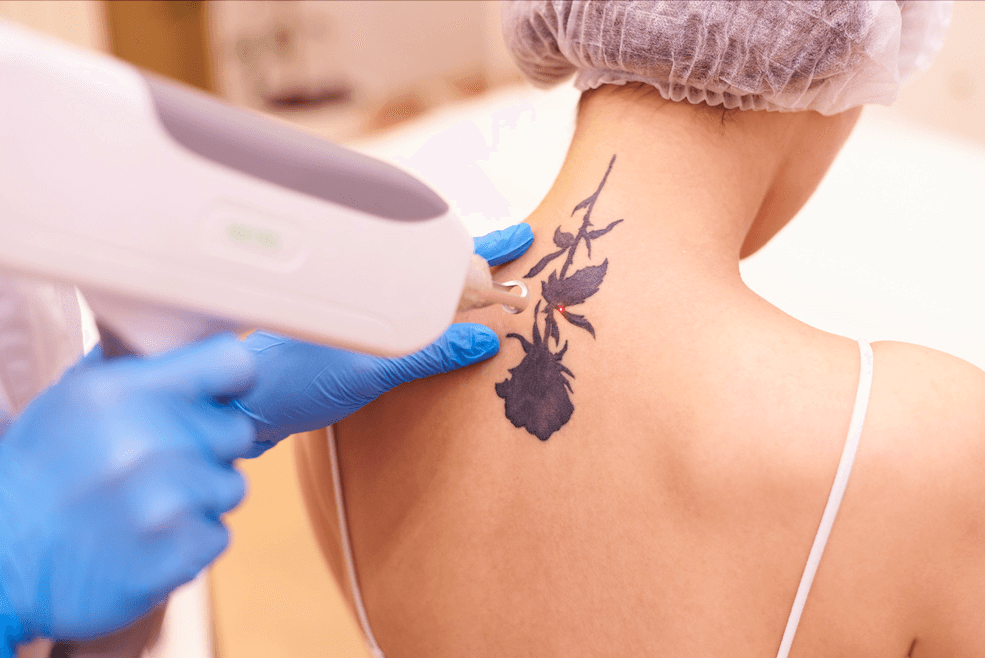 Start Laser Tattoo Removal Treatments Now and Be Tattoo Free By Summer