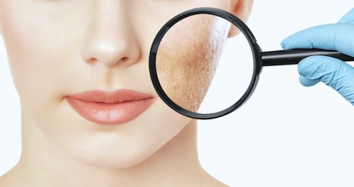 How to Take Control of Your Acne Scars Photo