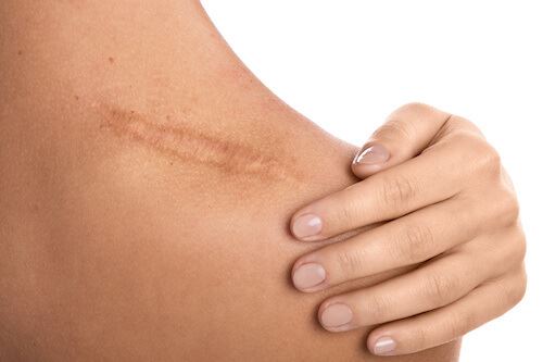 How to Get Impressive Results with a Laser Treatment for Scars Photo