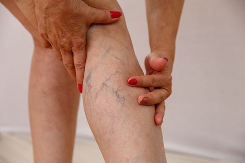What to do About the Bulging Veins in Your Legs Photo