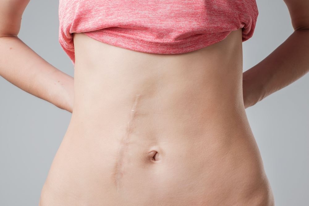 What to Expect During Laser Scar Revision Treatments Photo