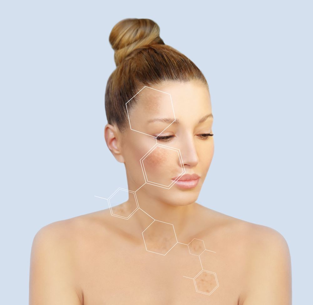 What to Know About the Three Types of Hyperpigmentation Photo