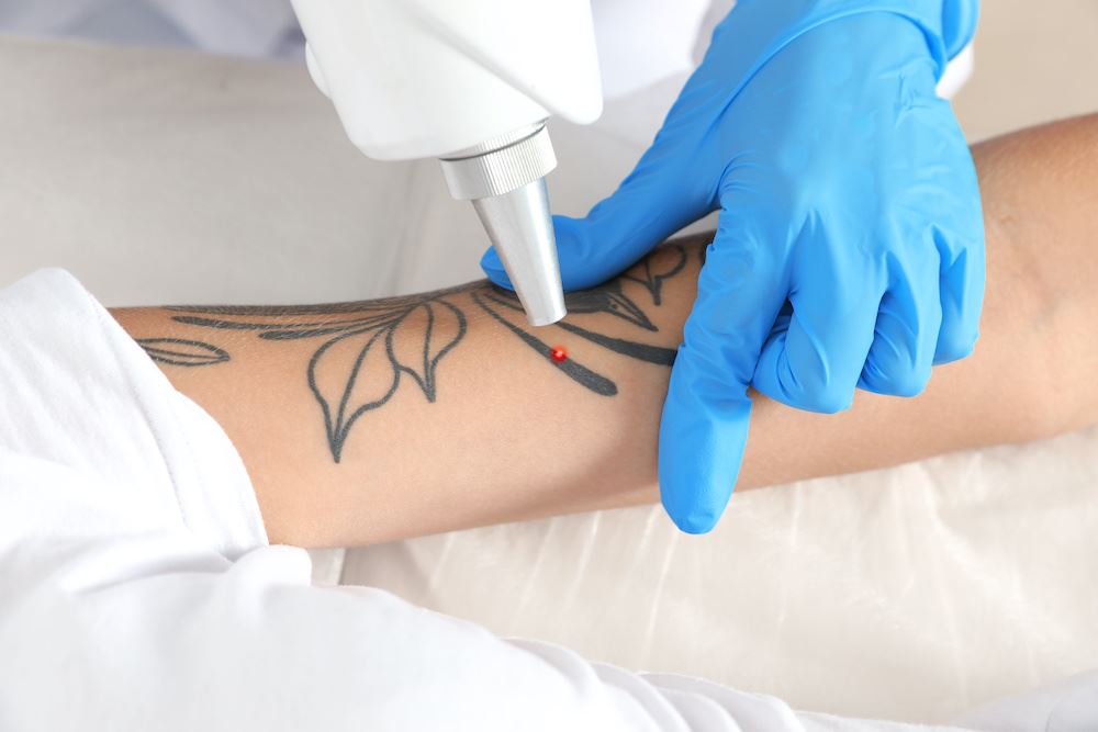 4 Misconceptions About Laser Tattoo Removal Photo