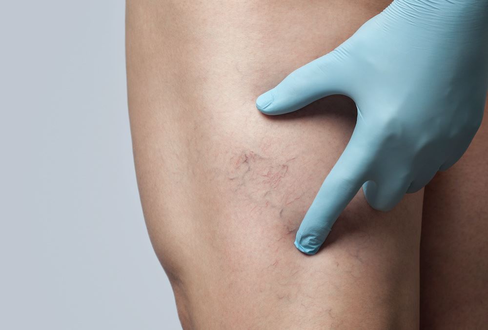 Summer-Ready Legs: Discovering Laser Treatments for Spider Vein Removal Photo