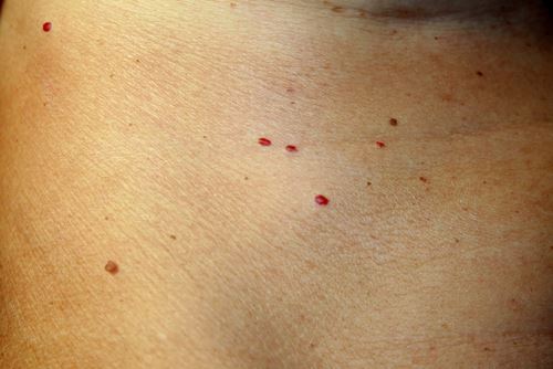 What is a Cherry Angioma? Photo
