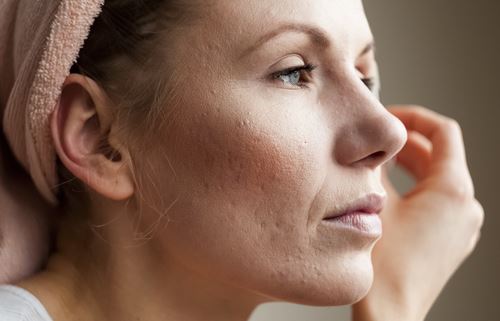 Where Does Adult Acne Come From? Photo