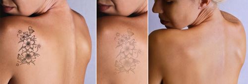 Which Laser is Best for Tattoo Removal? Photo