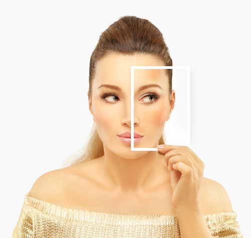 Will You Ever See Post Acne Hyperpigmentation Go Away? Photo