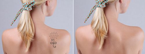Erasing Unpleasantries: A (Short) FAQ to Removing Tattoos Photo