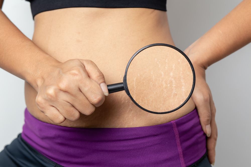 Get Rid of Unwanted Stretch Marks Effectively With A VirtueRF Treatment Photo