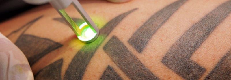 Tattoo Removal Treatment : Yes to Second Chances Photo