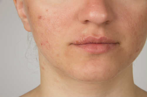 3 Reasons Why Scar Revision is Right for You Photo
