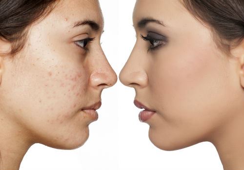 3 Reasons for a Sudden Burst of Acne Photo