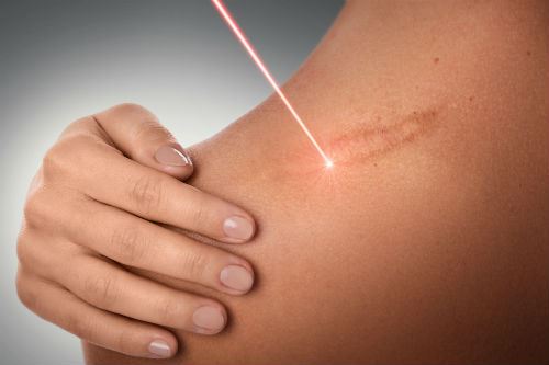 A Guide for Laser Scar Revision Photo
