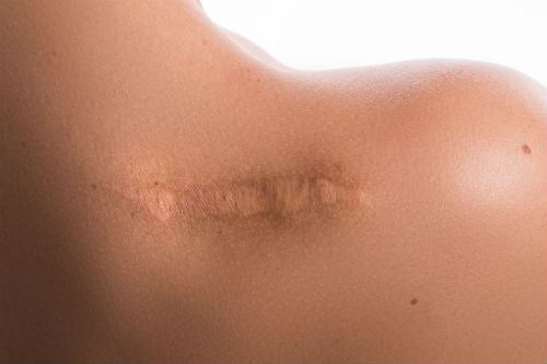 Are Lasers or Surgery Best for Scar Revision? Photo
