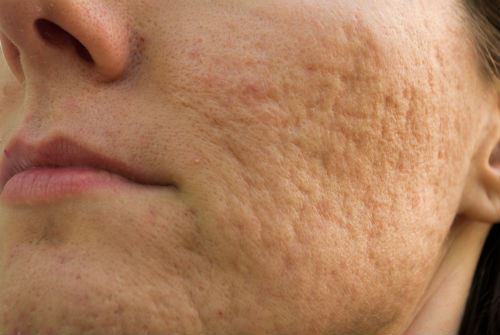 The Difference Between Acne Marks and Acne Scars Photo